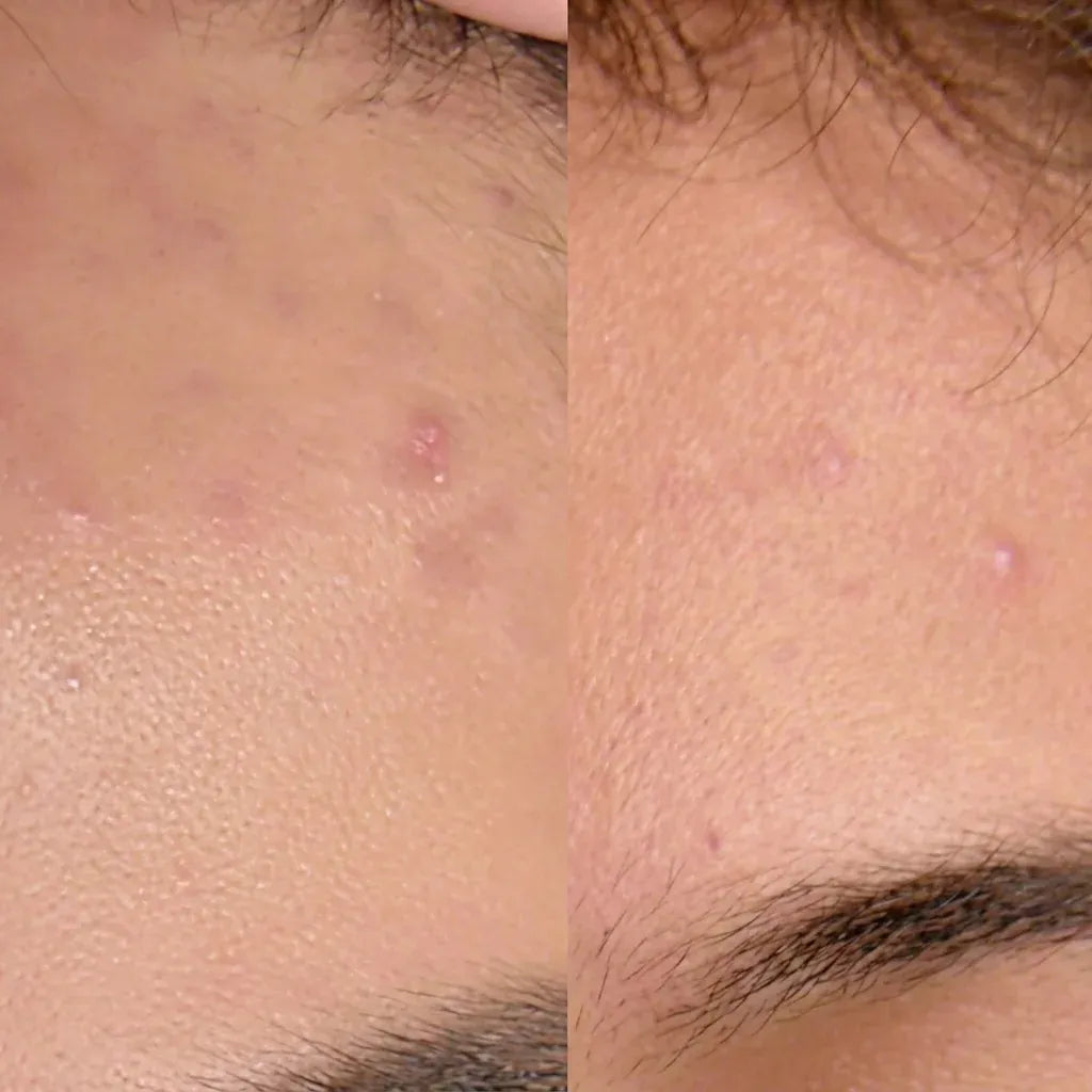 Antes y después en la frente: piel más uniforme