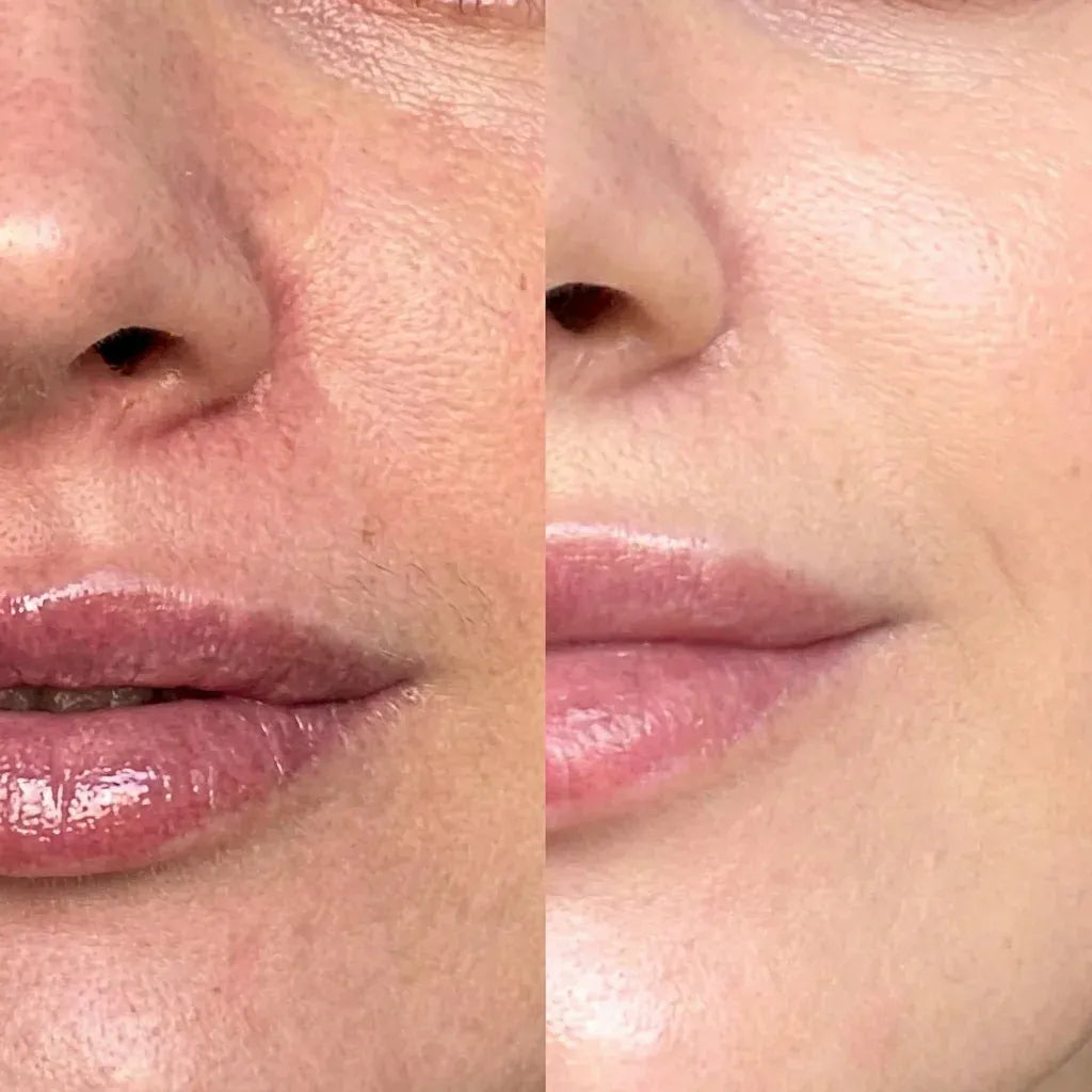 Antes y después en el contorno de labios: líneas más suaves