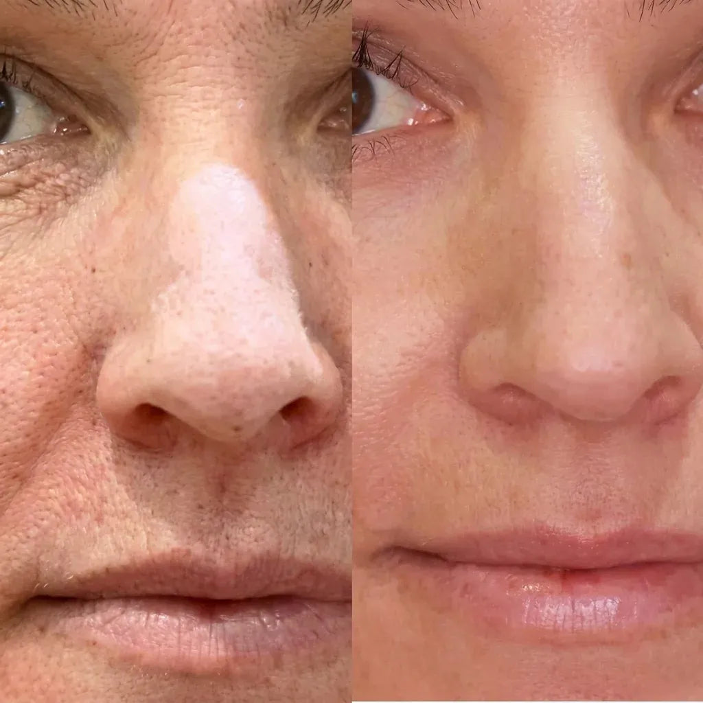 Antes y después en el contorno de ojos: manchas y líneas atenuadas