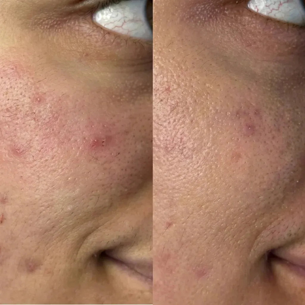 Antes y después en el pómulo: textura más pareja y menos rojeces
