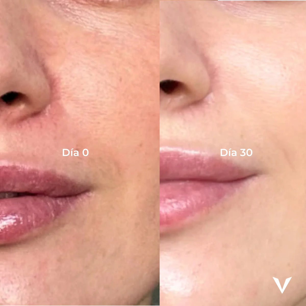 Antes y después en los labios: día 0 y día 30